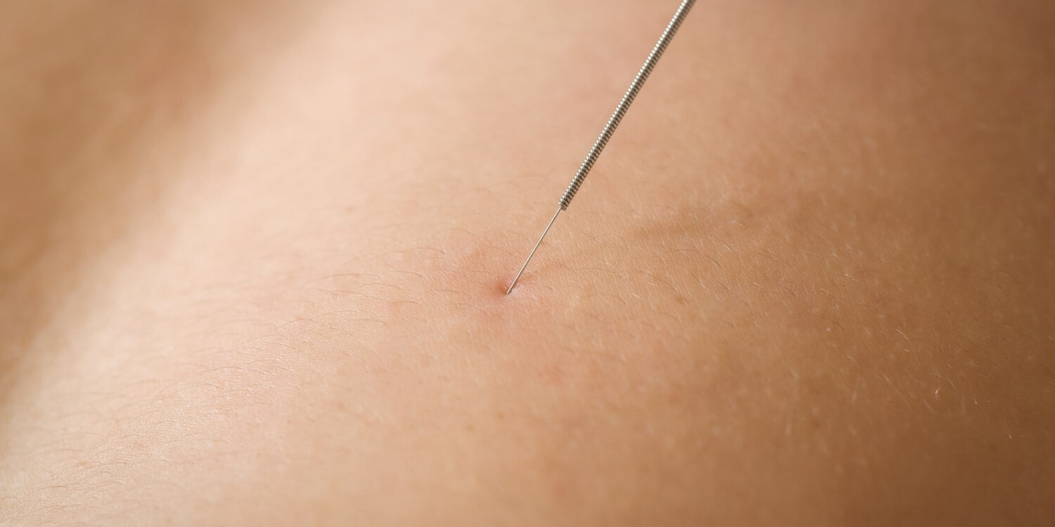 Positieve effecten dry needling Patient heeft een dry needling naald om de positieve effecten van dry needling te ervaren