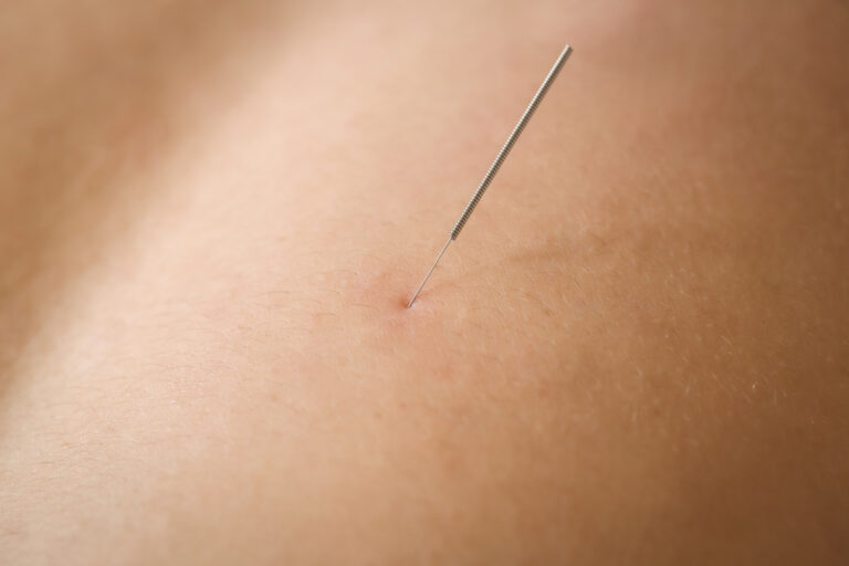 Patient heeft een dry needling naald om de positieve effecten van dry needling te ervaren