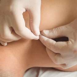 Man krijgt dry needling van een fysiotherapeut met handschoenen.