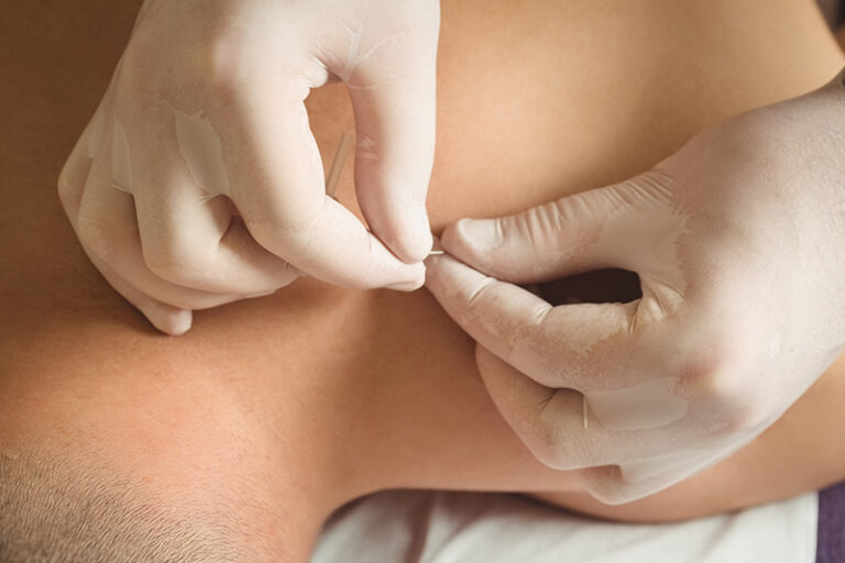 Patiënt krijgt dry needling bij terugkerende spierklachten en wordt geholpen door een fysiotherapeut met twee witte handschoenen aan.