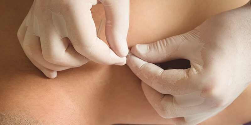 Patiënt krijgt dry needling bij terugkerende spierklachten en wordt geholpen door een fysiotherapeut met twee witte handschoenen aan.